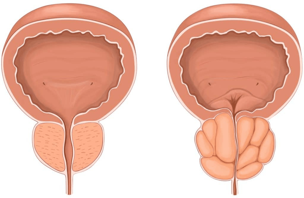 Co dzieje się z prostatą podczas zapalenia prostaty