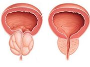 Zapalenie prostaty